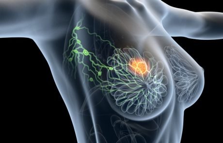 Dépistage du cancer du sein : lancement d’une vaste étude européenne