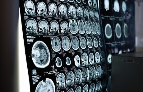 Spanish researchers develop new imaging tool to detect inflammation in the brain