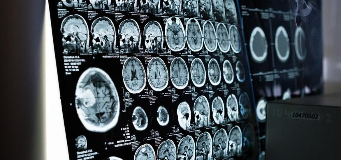 Spanish researchers develop new imaging tool to detect inflammation in the brain