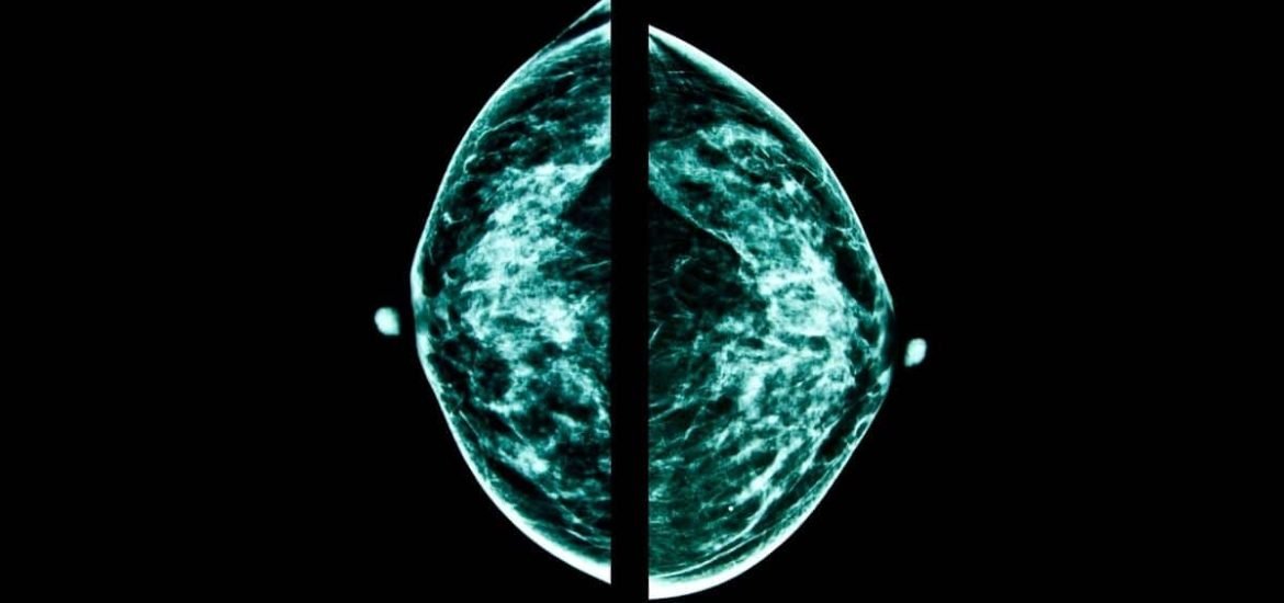 AI holds promise as a tool for breast cancer screening