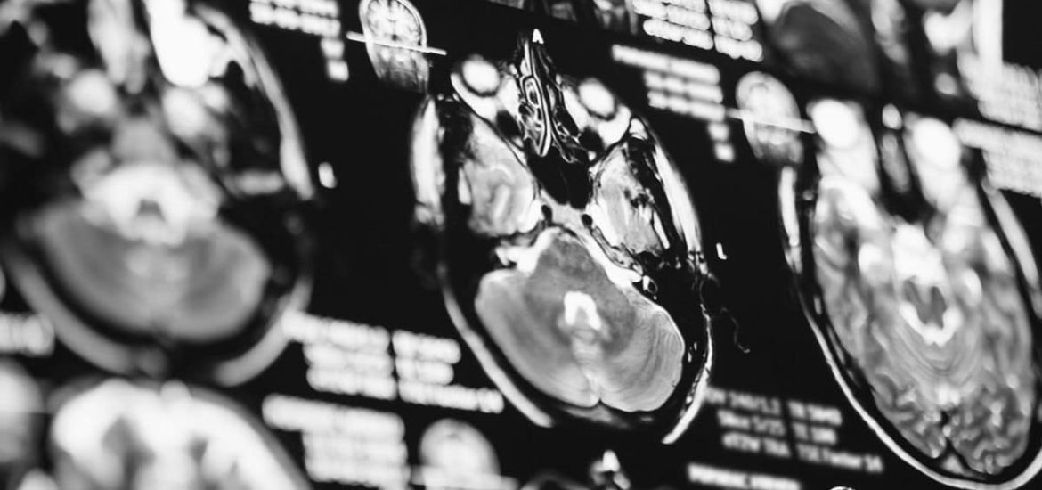 Neurologists warn COVID-19 can affect the brain too