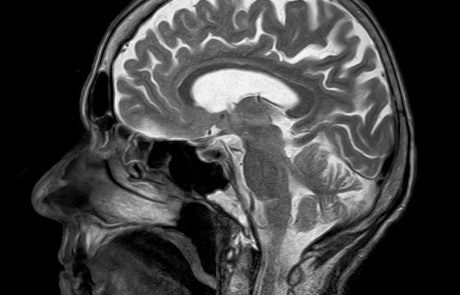 AI model to identify abnormalities in MRI scans