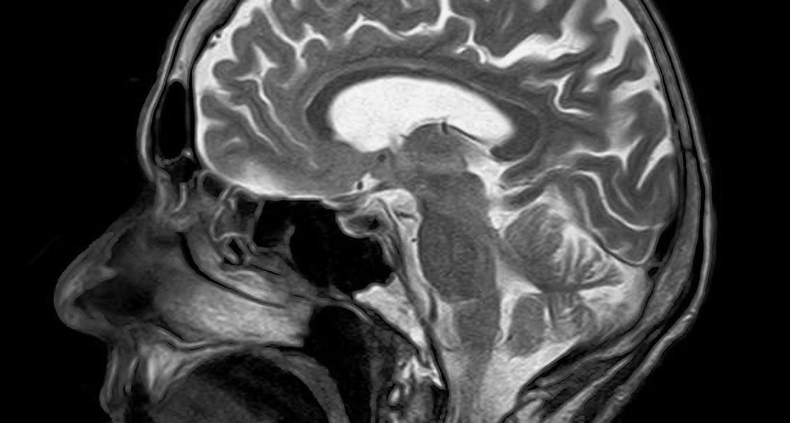 AI model to identify abnormalities in MRI scans