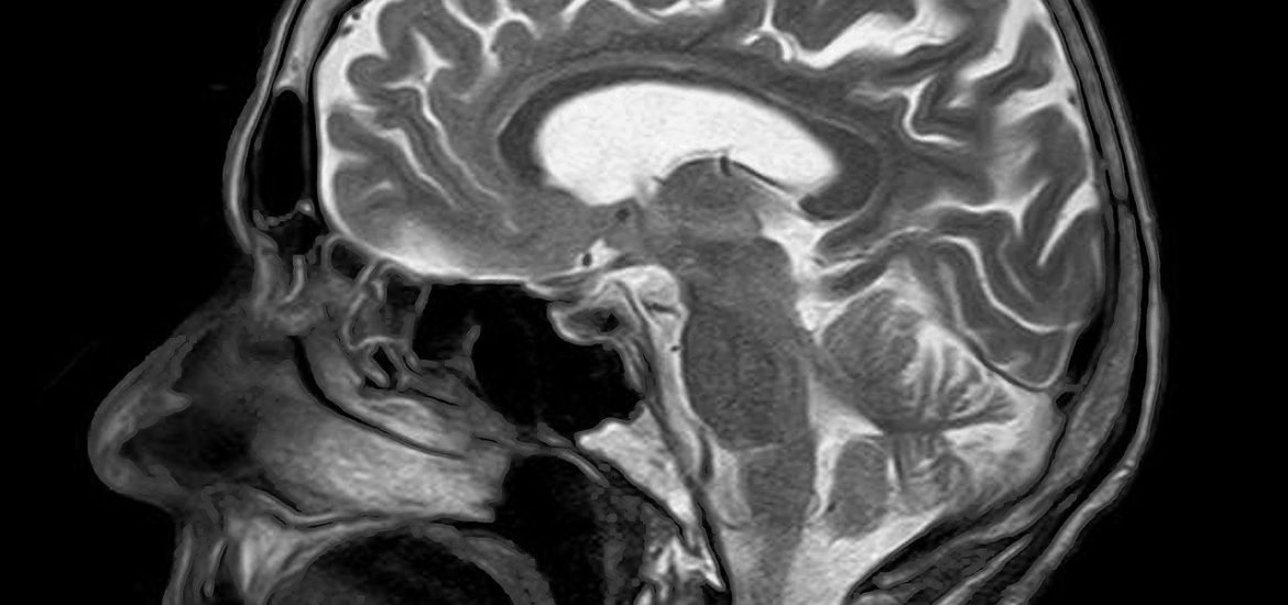 AI model to identify abnormalities in MRI scans