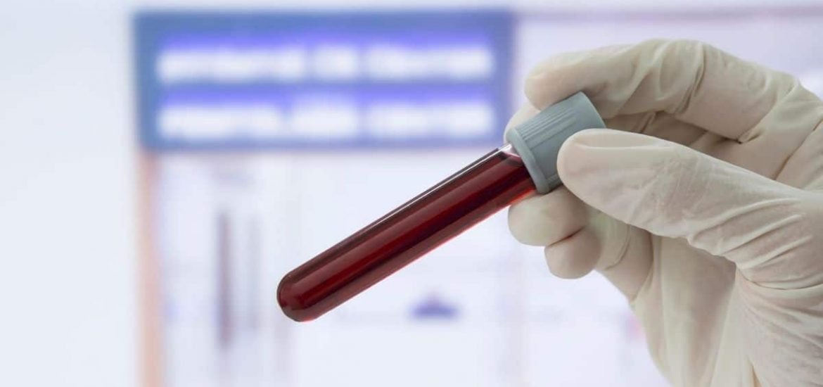 A simple blood test can detect cancer years before symptoms