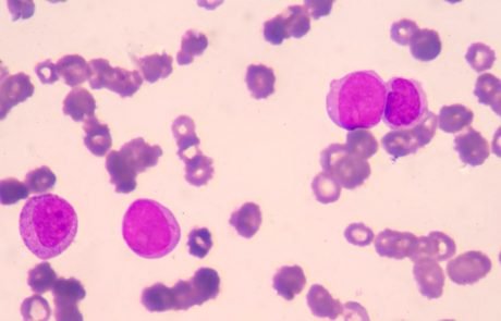 Compound in eyedrops may be a plausible therapeutic target against leukaemia