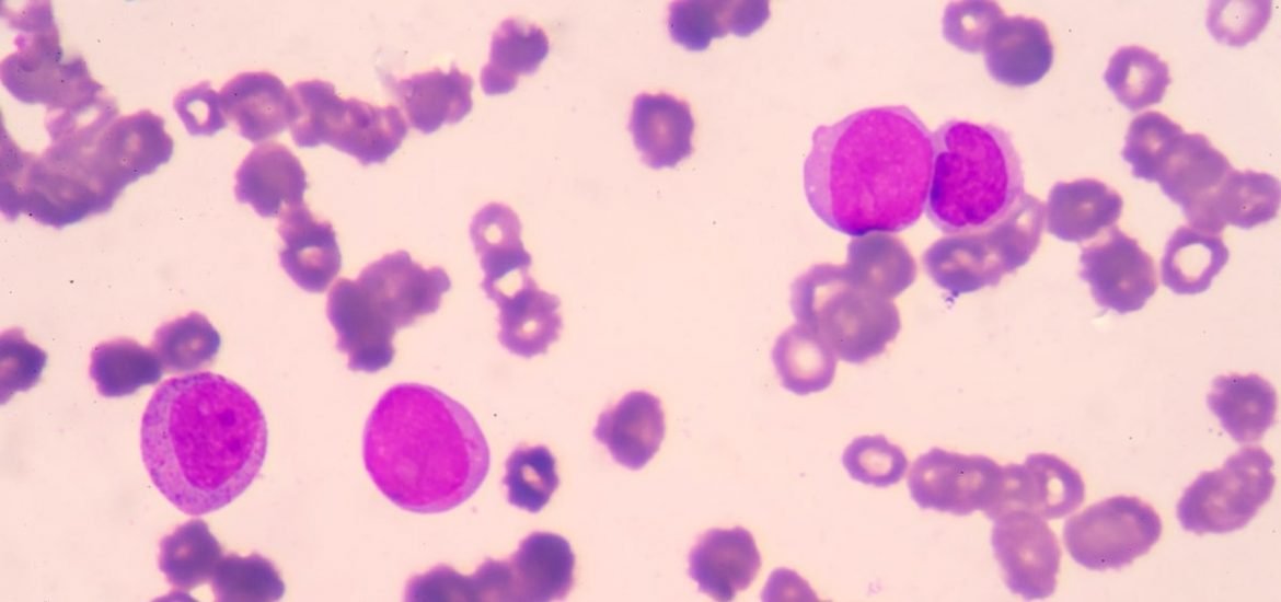 Compound in eyedrops may be a plausible therapeutic target against leukaemia