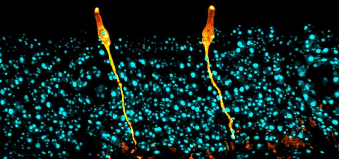 New lung cell type discovered that plays a key role in cystic fibrosis