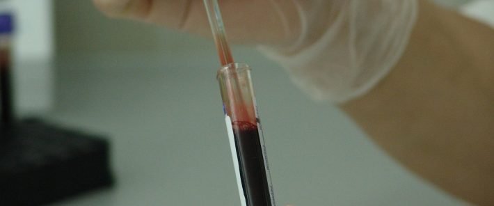 La mutation génétique qui protège contre le VIH existe depuis -7000 ans av J-C
